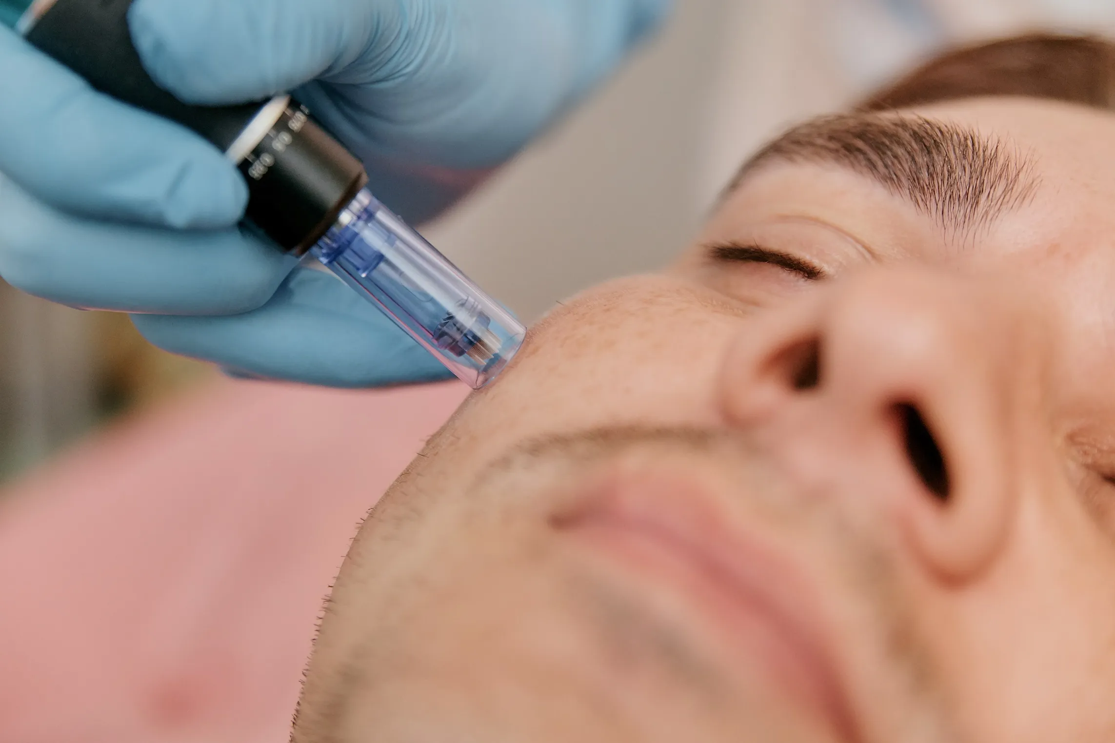 Microneedling-with-Exosomes-in-Just-for-men-by-Azul-blanca-medspa-in-pine-grove-mills-