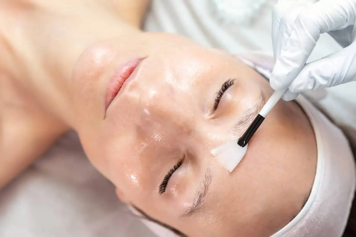 The Benefits of Chemical Peels- What They Can Do for Your Skin