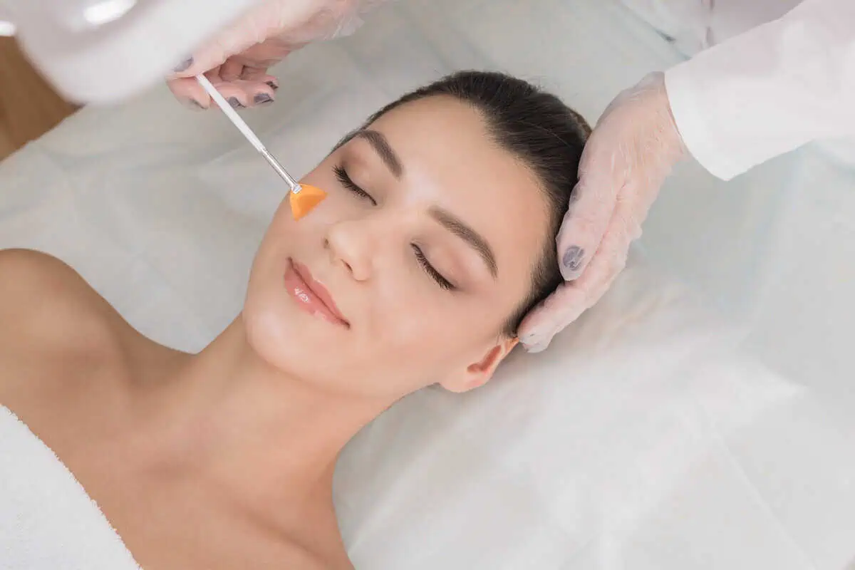 Top 5 Benefits of Chemical Peels You Can't Ignore